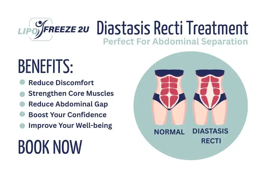 How Long Will It Take to See Improvements in Diastasis Recti Northampton