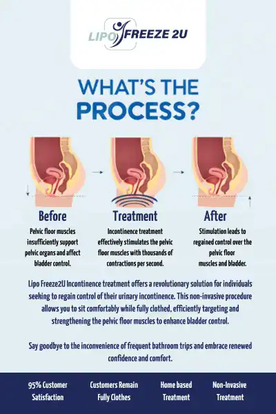 Diagram of how incontinence treatment Northampton works.