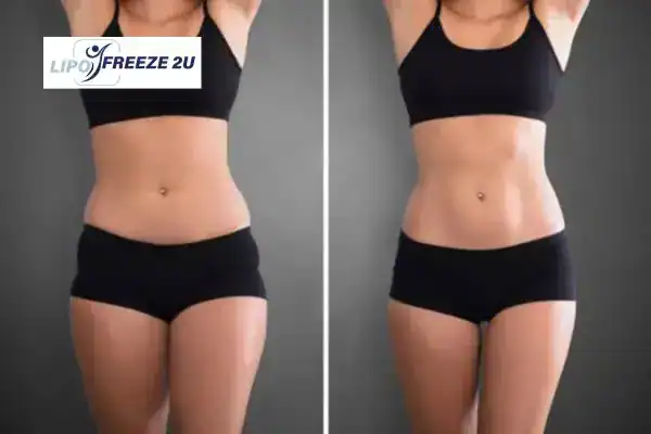 How Can LIPO FREEZE 2U Support Your Post-Pregnancy Body Recovery Northampton?