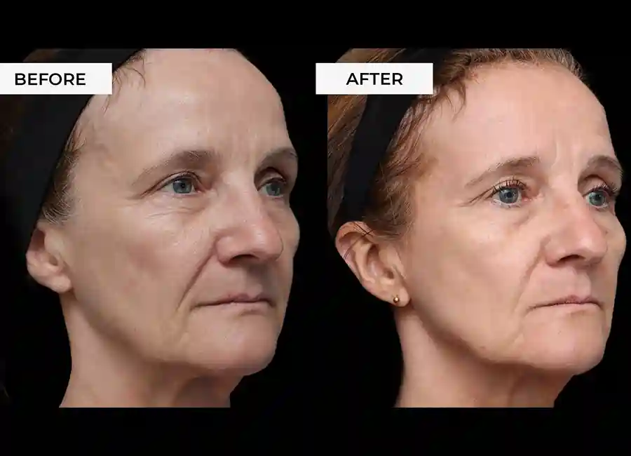 How Many RF Microneedling Sessions Will You Need to See a Difference Northampton?