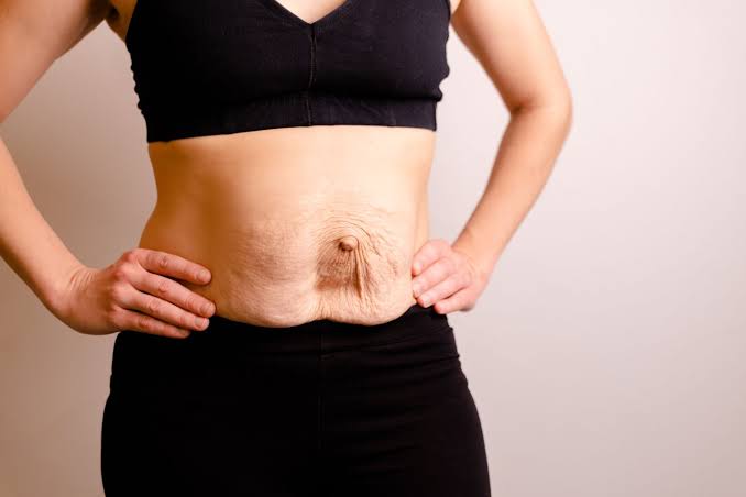 Is Surgery Really the Only Way to Repair Diastasis Recti Northampton?