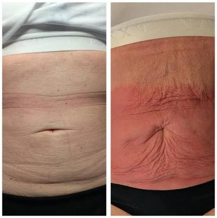 How Does RF Microneedling Improve Crepey, Thin and Uneven Skin Texture Northampton?