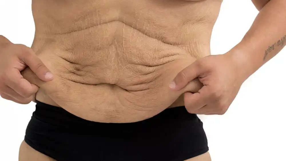 RF Microneedling for Loose Skin: How Can It Help Tighten and Reshape the Skin Northampton?
